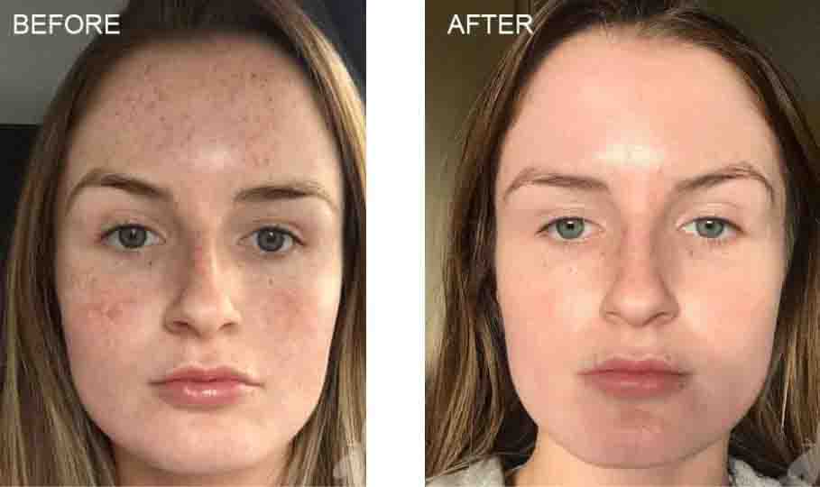 chemical peel before after