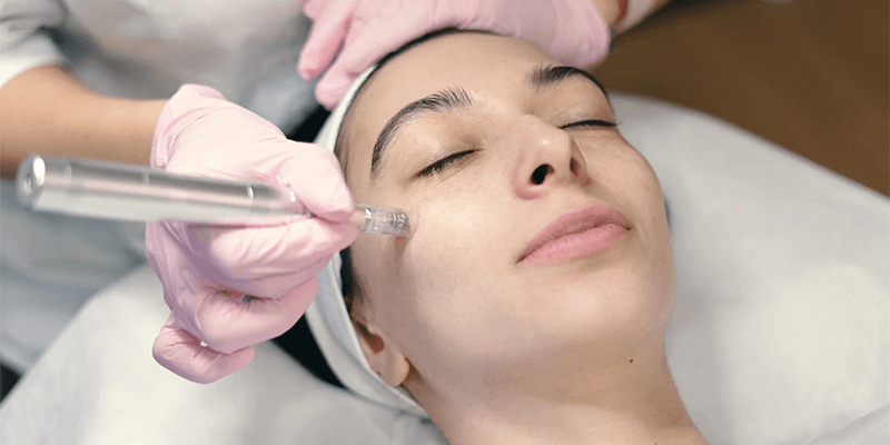 THE BENIFITS OF MICRONEEDLING